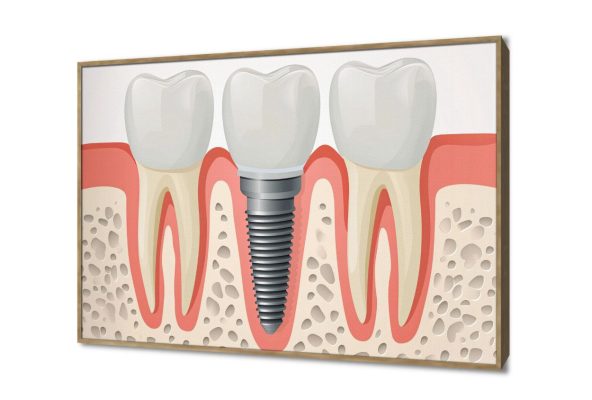 تابلوه مودرن طبى لزراعة وتجميل الاسنان SA107455 كل التابلوهات المودرن, اعمال و شركات, عيادات - طبيه - مستشفيات ابيض - اوف 와يت, احمر - نبيتى, اسود الستريشن - فيكتور, مودرن مكاتب – شركات - اعمال بالعرض, ببرواز, برواز خشبى, مستطيل