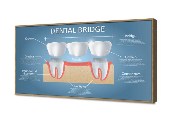 تابلوه مودرن لشرح تركيبات الأسنان الطبية SA107523 كل التابلوهات المودرن, اعمال و شركات, عيادات - طبيه - مستشفيات ابيض - اوف وايت, ازرق - تركواز ديجيتال آرت, قابل للتعديل, كتابات و حروف, مودرن مكاتب – شركات - اعمال بالعرض, ببرواز, برواز خشبى, مستطيل