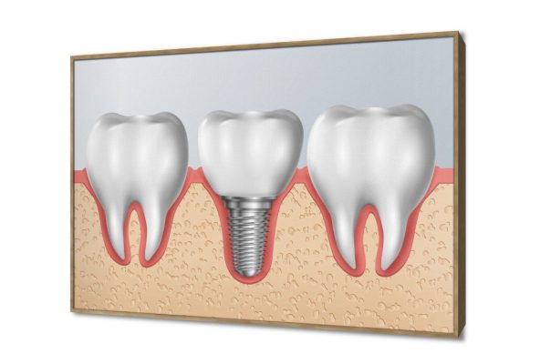 تابلوه مودرن طب اسنان وزراعة اسنان SA107563 كل التابلوهات المودرن, اعمال و شركات, عيادات - طبيه - مستشفيات ابيض - اوف وايت, بنى - بيج ديجيتال آرت, مودرن عيادات - طبيه - مستشفيات بالعرض, ببرواز, برواز خشبى, مستطيل